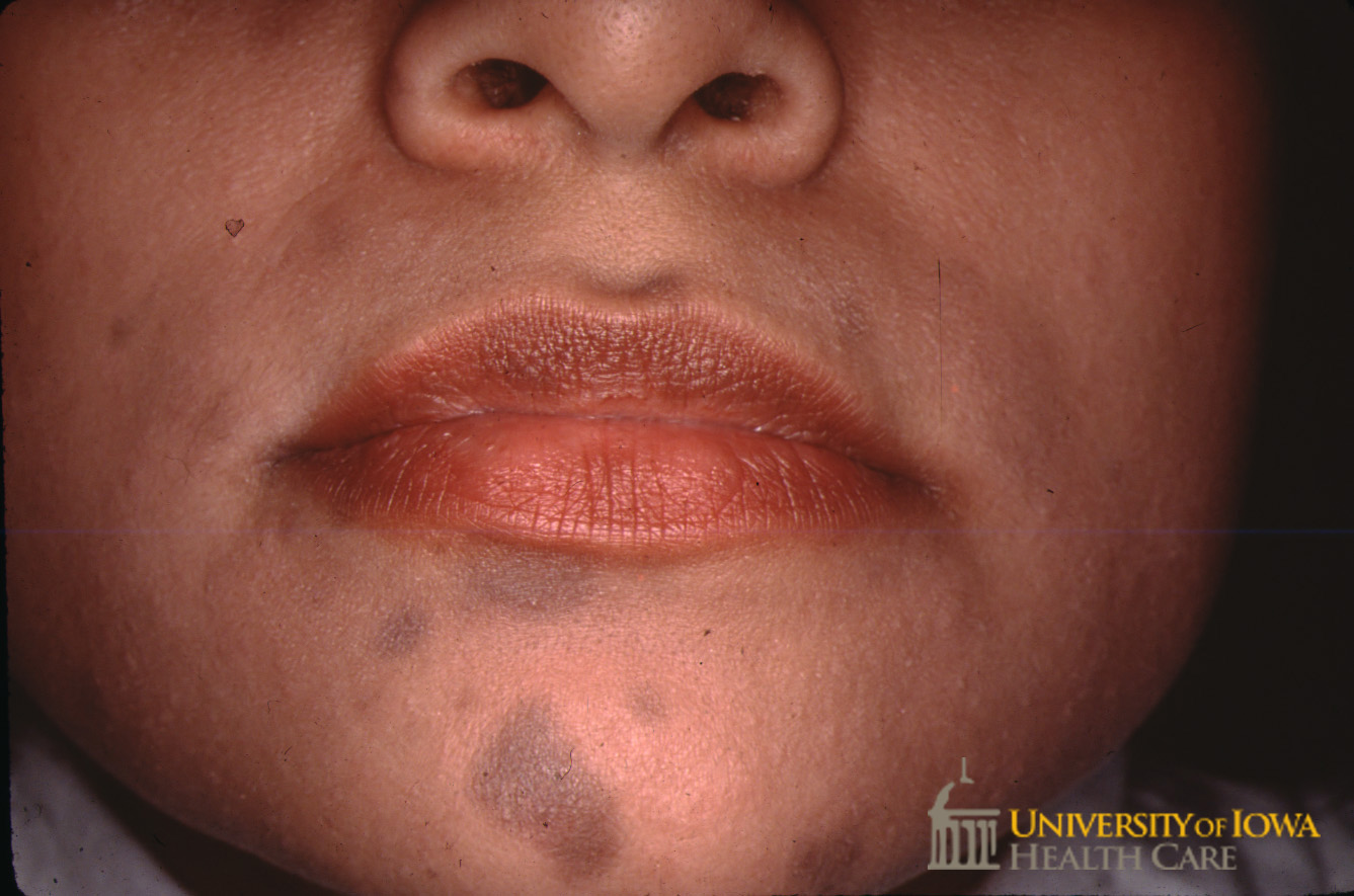 Brown-gray ovoid patches on the chin. (click images for higher resolution).